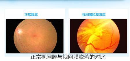 视网膜脱落明星,揭秘视网膜脱落背后的明星故事